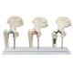 Modèle anatomique du joint de hanche (sain, malade, implant) Erler Zimmer